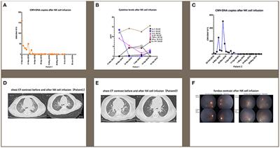 Natural killer cell infusion for cytomegalovirus infection in pediatric patients with Wiskott-Aldrich syndrome following cord blood transplantation: A case report and literature review